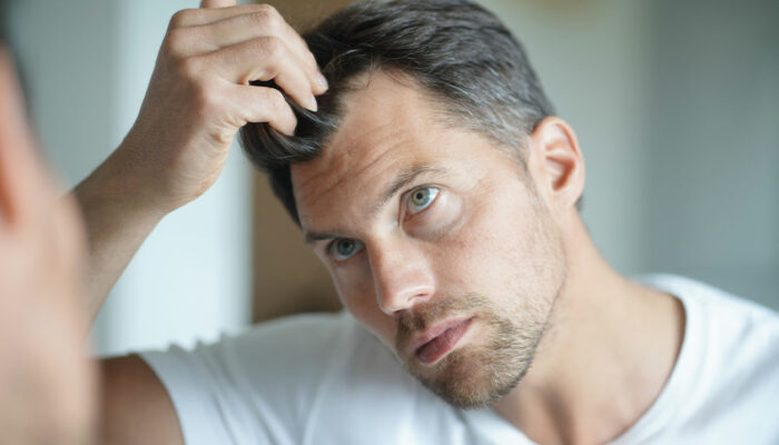 6 Health Conditions That Trigger Severe Hair Loss